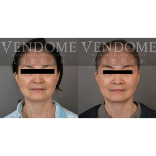 54歲女性 中下臉與頸部拉皮 淡化法令紋 膨潤蘋果肌 改善臉部細紋 增加整體面部光澤感