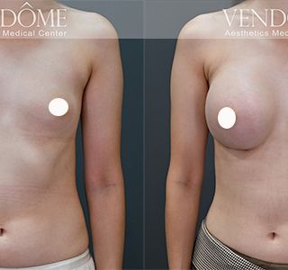 術前 A cup -> 術後 E cup 原本平胸的案例，接受女王波隆乳後，沿原本胸廓，打造大而飽滿的美胸。 療程效果因人而異，上圖為該案例實際進行果凍矽膠隆乳手術後之成效