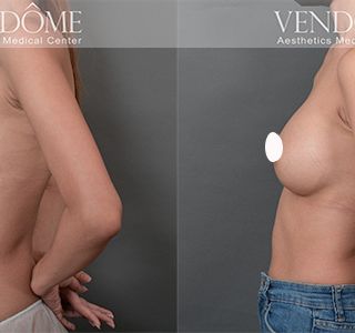 術前 A cup -> 術後 E cup 原本平胸的案例，接受女王波隆乳後，得到尋求已久的曲線感，沿原胸部廓型打造渾圓自然美胸。 療程效果因人而異，上圖為該案例實際進行果凍矽膠隆乳手術後之成效