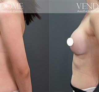 術前 A cup -> 術後 E cup 原本平胸的案例，接受女王波隆乳後，沿原本胸廓，打造大而飽滿的美胸。 療程效果因人而異，上圖為該案例實際進行果凍矽膠隆乳手術後之成效