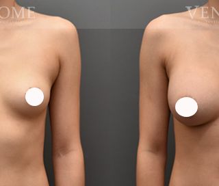 術前 B cup -> 術後 E cup 透過女王波隆乳，打造渾圓的水滴型胸型與乳溝，整體更具曲線感。 療程效果因人而異，上圖為該案例實際進行果凍矽膠隆乳手術後之成效