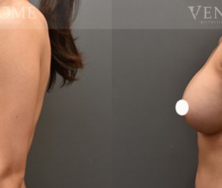 術前 B cup -> 術後 E cup 透過女王波隆乳，打造渾圓的水滴型胸型與乳溝，整體更具曲線感。 療程效果因人而異，上圖為該案例實際進行果凍矽膠隆乳手術後之成效