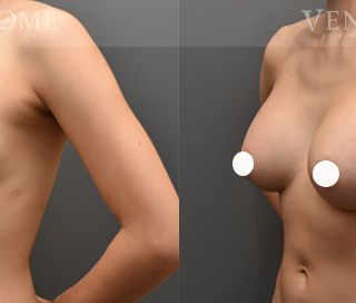 術前 B cup -> 術後 E cup 透過女王波隆乳，打造渾圓的水滴型胸型與乳溝，整體更具曲線感。 療程效果因人而異，上圖為該案例實際進行果凍矽膠隆乳手術後之成效