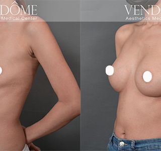 術前 A cup -> 術後 E cup 原本平胸的案例，接受女王波隆乳後，得到尋求已久的曲線感，沿原胸部廓型打造渾圓自然美胸。 療程效果因人而異，上圖為該案例實際進行果凍矽膠隆乳手術後之成效