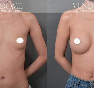 術前 A cup -> 術後 E cup 原本平胸的案例，接受女王波隆乳後，得到尋求已久的曲線感，沿原胸部廓型打造渾圓自然美胸。 療程效果因人而異，上圖為該案例實際進行果凍矽膠隆乳手術後之成效