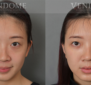 療程效果因人而異，上圖為該案例實際進行眼袋手術術後之成效