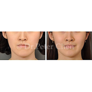 療程效果因人而異，上圖為上顎骨突出(暴牙)案例實際進行正顎手術術後之成效。