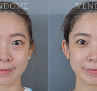 療程效果因人而異，上圖為該案例實際進行眼袋手術術後之成效