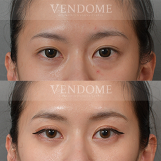 療程效果因人而異，上圖為該案例實際進行眼袋手術術後之成效