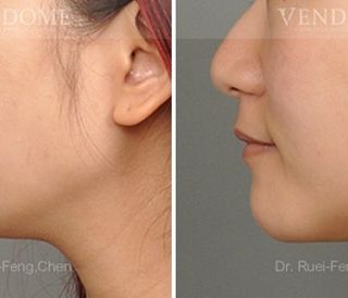 療程效果因人而異，上圖為該案例實際術後成效