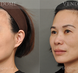 療程效果因人而異，上圖為該案例實際進行眼袋手術術後之成效