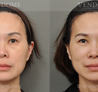 療程效果因人而異，上圖為該案例實際進行眼袋手術術後之成效