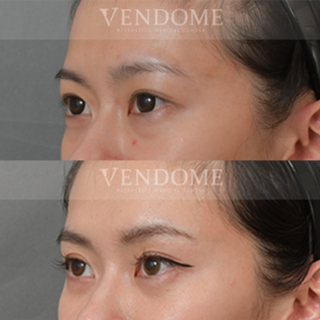 療程效果因人而異，上圖為該案例實際進行眼袋手術術後之成效