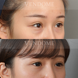 療程效果因人而異，上圖為該案例實際進行眼袋手術術後之成效