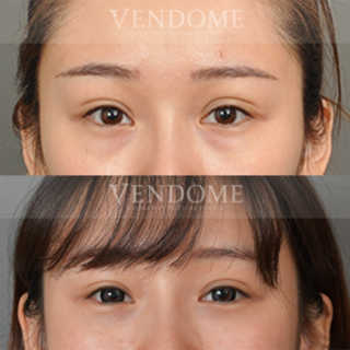 療程效果因人而異，上圖為該案例實際進行眼袋手術術後之成效