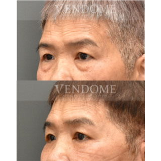 療程效果因人而異，上圖為該案例實際進行眼袋手術術後之成效