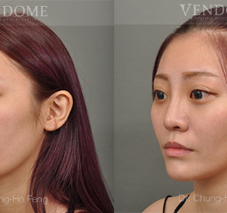 療程效果因人而異，上圖為該案例實際進行眼袋手術術後之成效