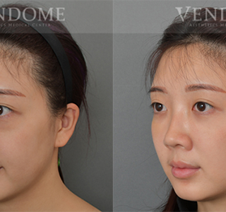 療程效果因人而異，上圖為該案例實際進行眼袋手術術後之成效