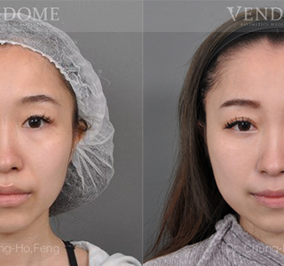 療程效果因人而異，上圖為該案例實際進行眼袋手術術後之成效