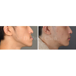 療程效果因人而異，上圖為中臉凹陷合併下顎突出案例實際進行正顎手術術後之成效。