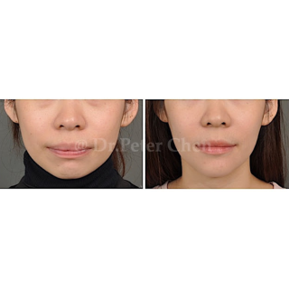 療程效果因人而異，上圖為上顎骨突出(暴牙)案例實際進行正顎手術術後之成效。