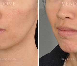 療程效果因人而異，上圖為該案例實際術後成效