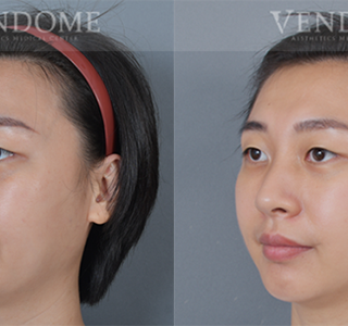 療程效果因人而異，上圖為該案例實際進行眼袋手術術後之成效