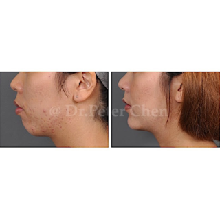 療程效果因人而異，上圖為上顎骨突出案例實際進行正顎手術術後之成效。