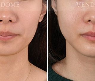 療程效果因人而異，上圖為該案例實際術後成效