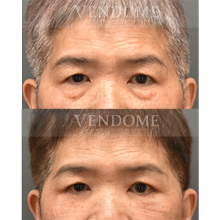 療程效果因人而異，上圖為該案例實際進行眼袋手術術後之成效