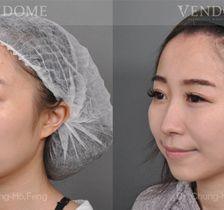 療程效果因人而異，上圖為該案例實際進行眼袋手術術後之成效