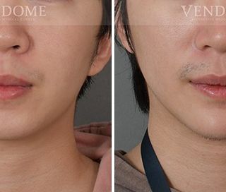 療程效果因人而異，上圖為該案例實際術後成效