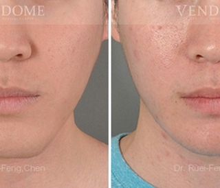 療程效果因人而異，上圖為該案例實際術後成效