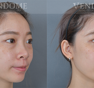 療程效果因人而異，上圖為該案例實際進行眼袋手術術後之成效