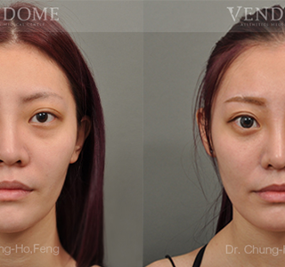 療程效果因人而異，上圖為該案例實際進行眼袋手術術後之成效