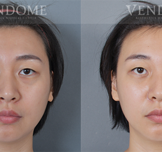 療程效果因人而異，上圖為該案例實際進行眼袋手術術後之成效