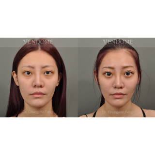 療程效果因人而異，上圖為該案例實際進行眼袋手術術後之成效