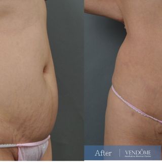 療程效果因人而異，上圖為該案例實際進行腹拉、腹部拉皮手術術後成效