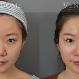 療程效果因人而異，上圖為該案例實際進行隆鼻手術、鼻翼拉提手術後之成效