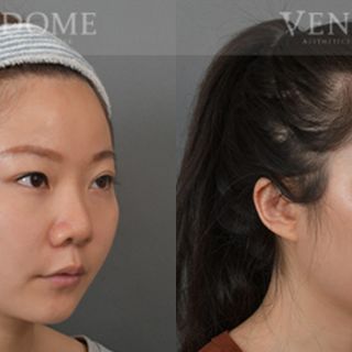 療程效果因人而異，上圖為該案例實際進行隆鼻手術、鼻翼拉提手術後之成效