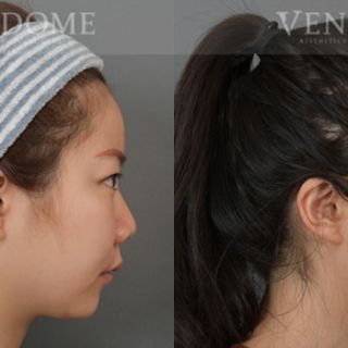 療程效果因人而異，上圖為該案例實際進行隆鼻手術、鼻翼拉提手術後之成效