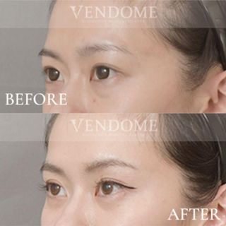 療程效果因人而異，上圖為該案例實際進行眼袋手術術後之成效