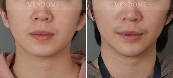 下巴手術案例分享 術後成效（正面）