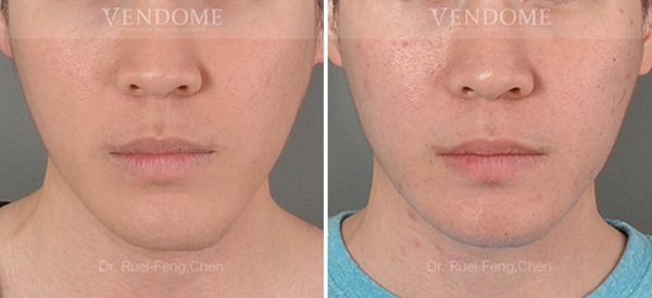 下巴手術案例分享 術後成效（正面）