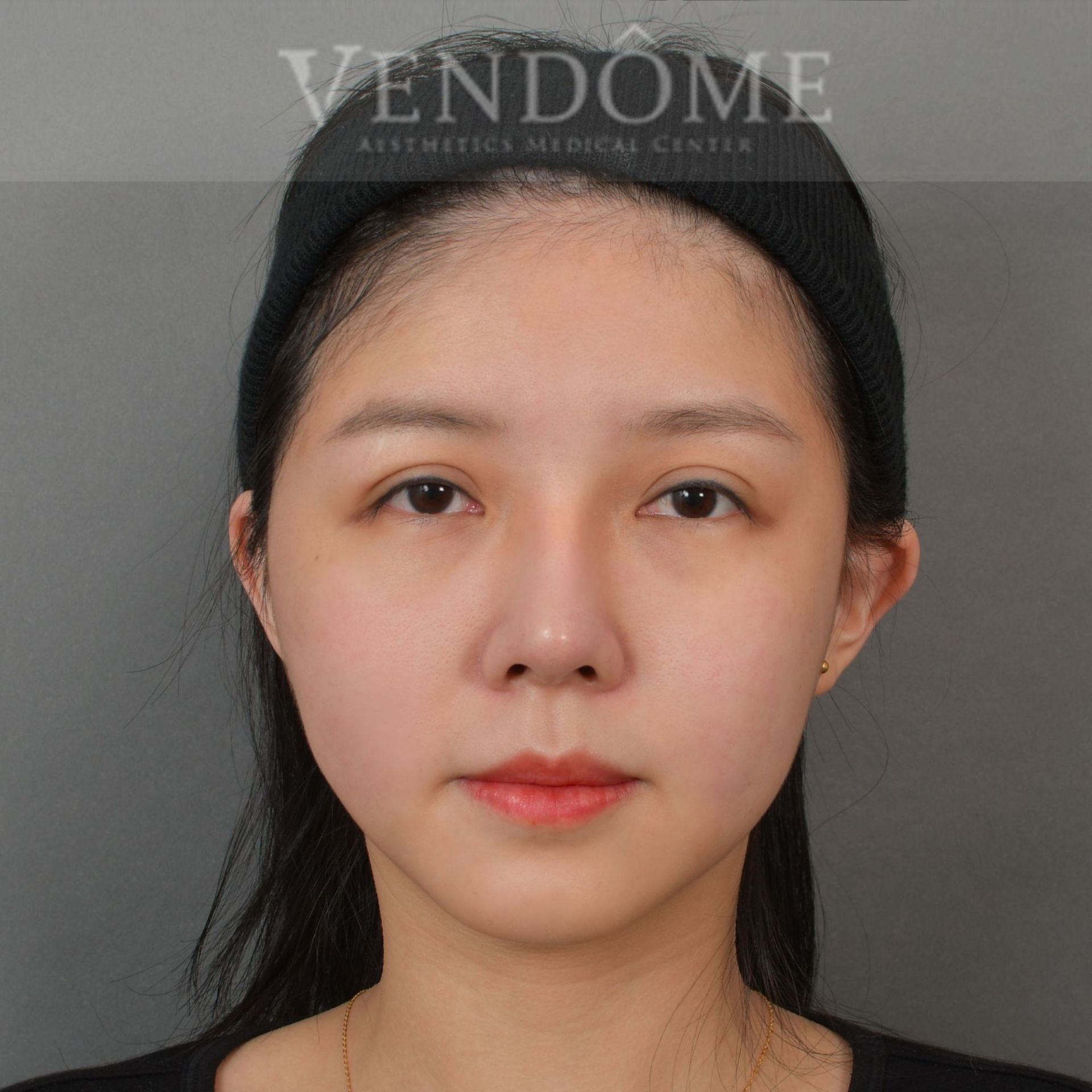 削骨手術合併自體脂肪填補 術後