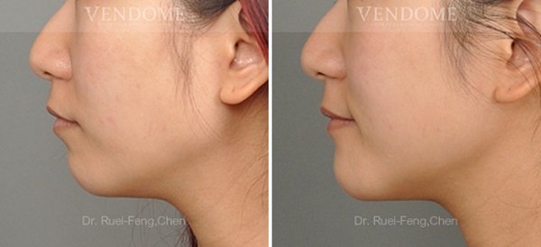 下巴手術案例分享 術後成效（側面）