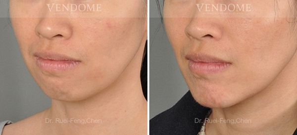 下巴手術案例分享 術後成效（斜側面）