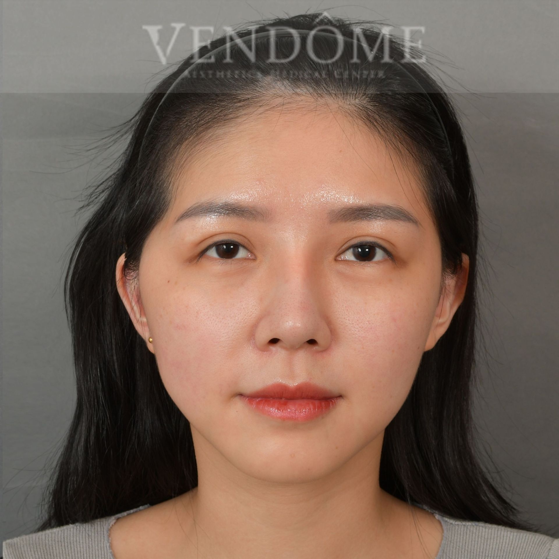 削骨手術合併自體脂肪填補 術前