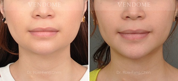 下巴手術案例分享 術後成效（正面）