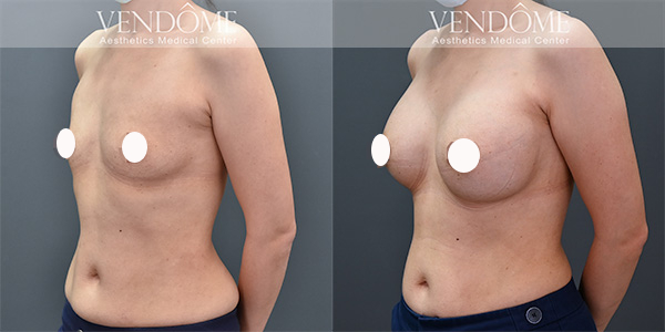 曼陀女王波隆乳推薦